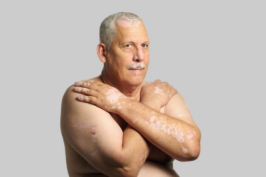 Grauhaariger Mann mit nacktem Oberkörper und sichtbarer Hautkrankheit verschränkt die Arme