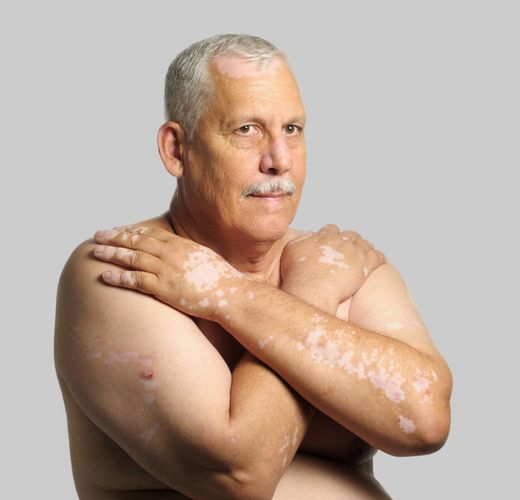 Grauhaariger Mann mit nacktem Oberkörper und sichtbarer Hautkrankheit verschränkt die Arme