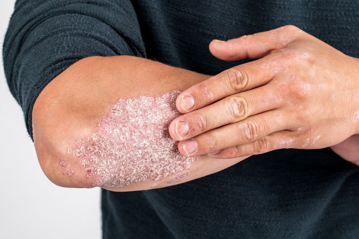 Unterarm mit Psoriasis-Hautstelle