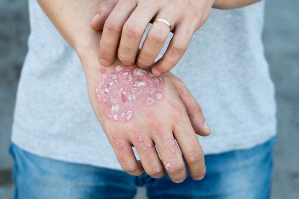 Handrücken mit Psoriasisplaques