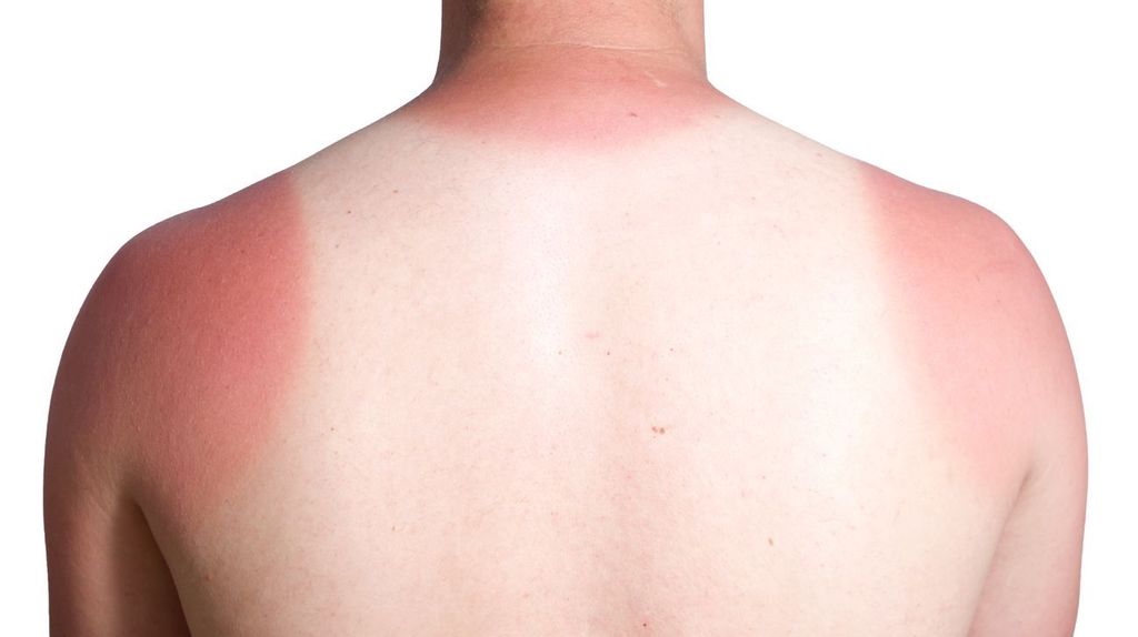 Sonnenverbrannter Rücken mit weißem Abdruck eines Unterhemdes 